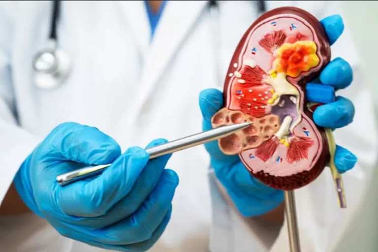 Kanker Ginjal Diprediksi Berlipat Ganda di 2050: Kebiasaan Sepele Ini Ternyata Jadi Pemicu Utama!